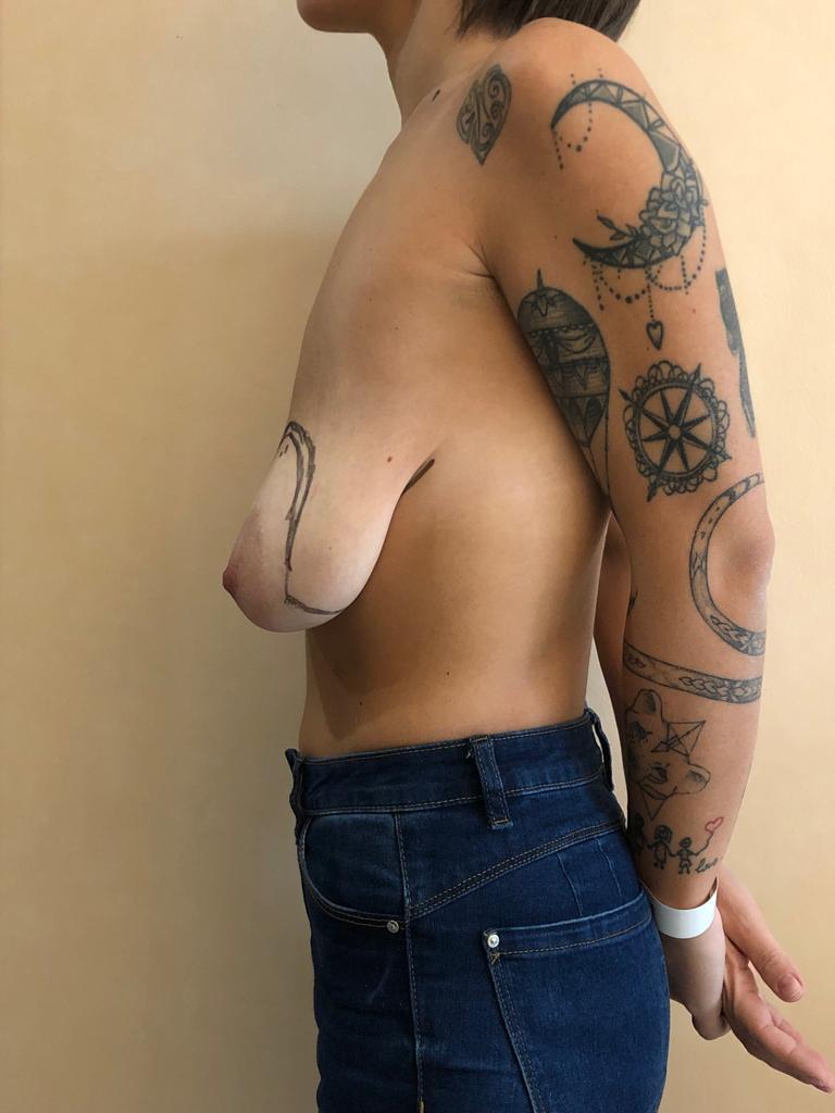 Seno, storia 07, dopo dimagrimento da sleeve, prima della mastopessi con protesi, vista di profilo