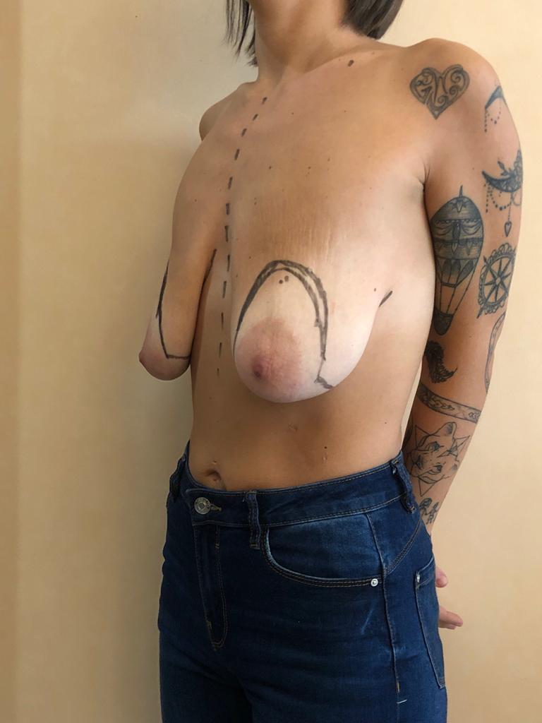 Seno, storia 07, dopo dimagrimento da sleeve, prima della mastopessi con protesi, vista in tre quarti